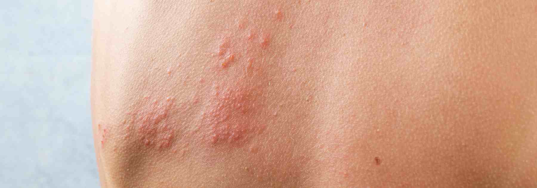 Access shingles treatment in Market Harborough today. 